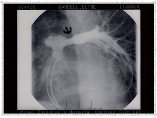 2010 - Left Pulmonary Artery Before